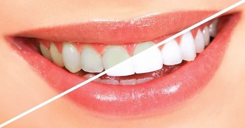 t عوارض استفاده از سفیدکننده های دندان